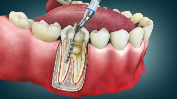 Endodoncia Endodoncia