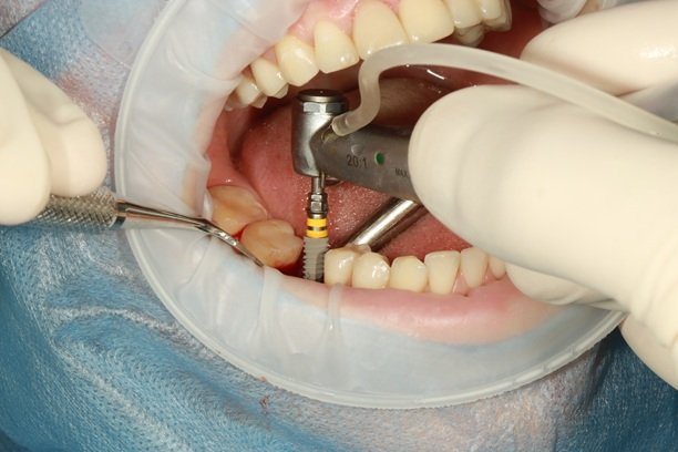 implantes-2