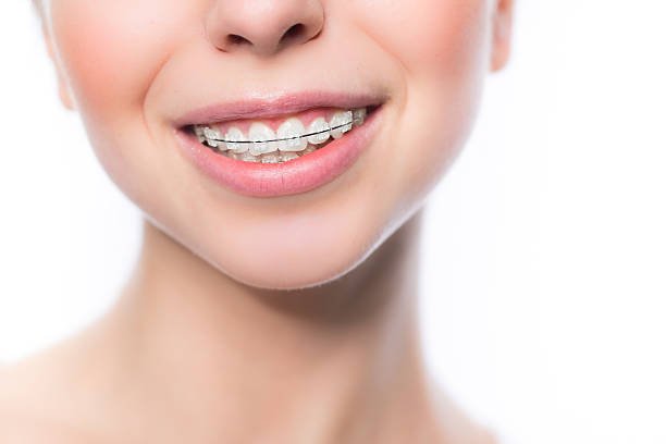 brackets brackets esteticos